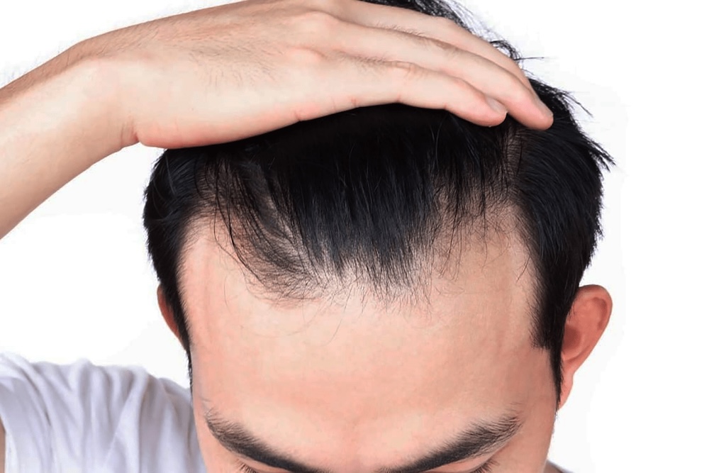 Trapianto di capelli