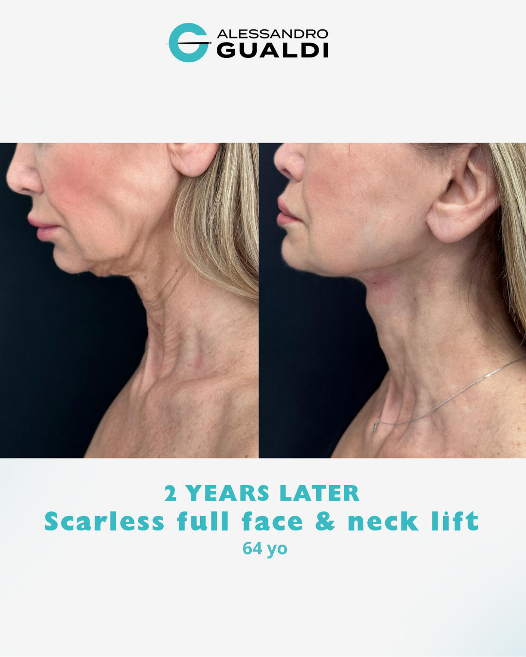 Think a non‑surgical treatment could match this  Impossible 