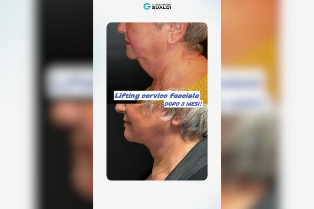 Lifting cervico facciale