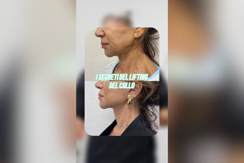 Collo Pesante Perché tirare la pelle NON basta Il Deep Neck Lift