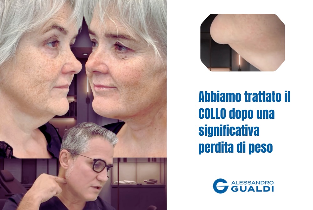 Lifting del collo: ridefinire il profilo dopo il dimagrimento