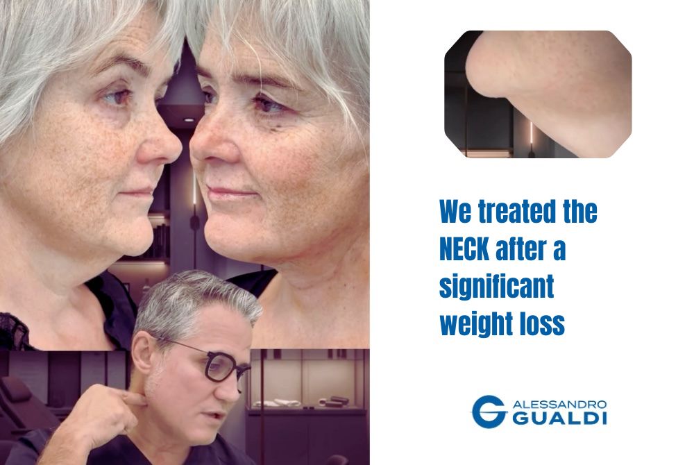 Neck lift after weight loss