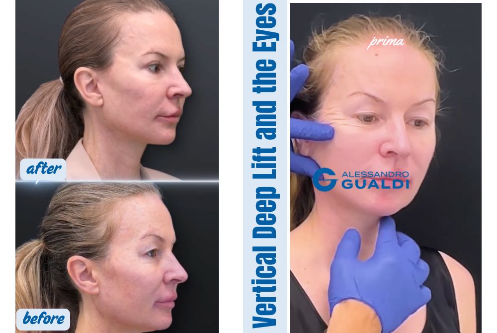 Deep Plane Facelift 47 years old