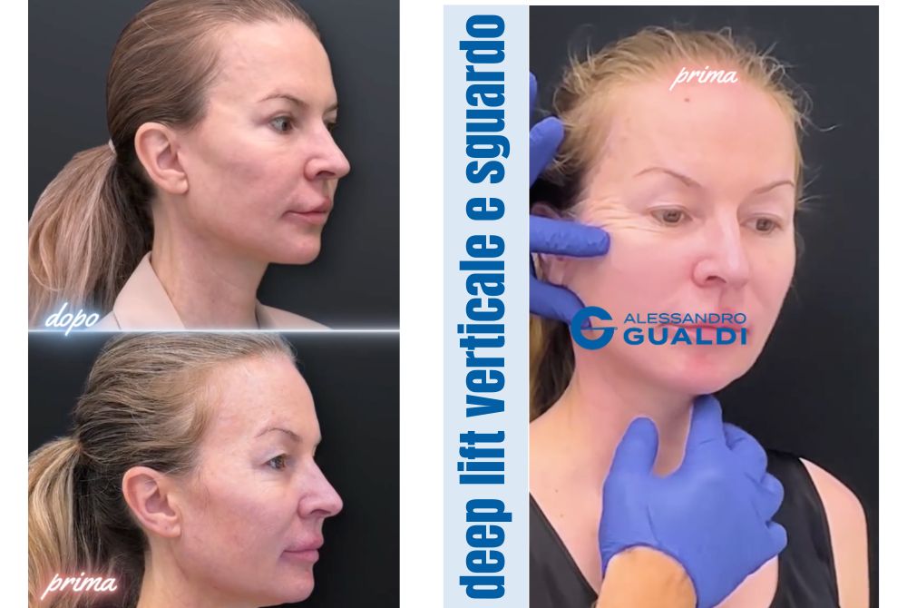 Deep Plane Facelift 47 anni
