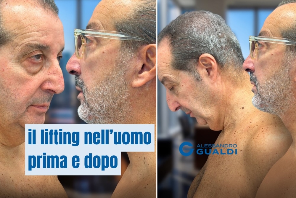 Deep Face Lift Uomo Milano