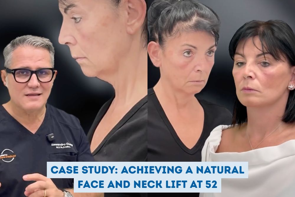 Face and neck lift case study