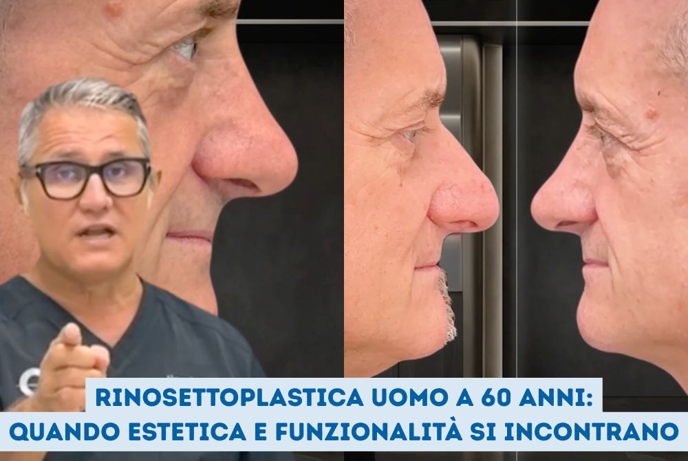 rinosettoplastica uomo