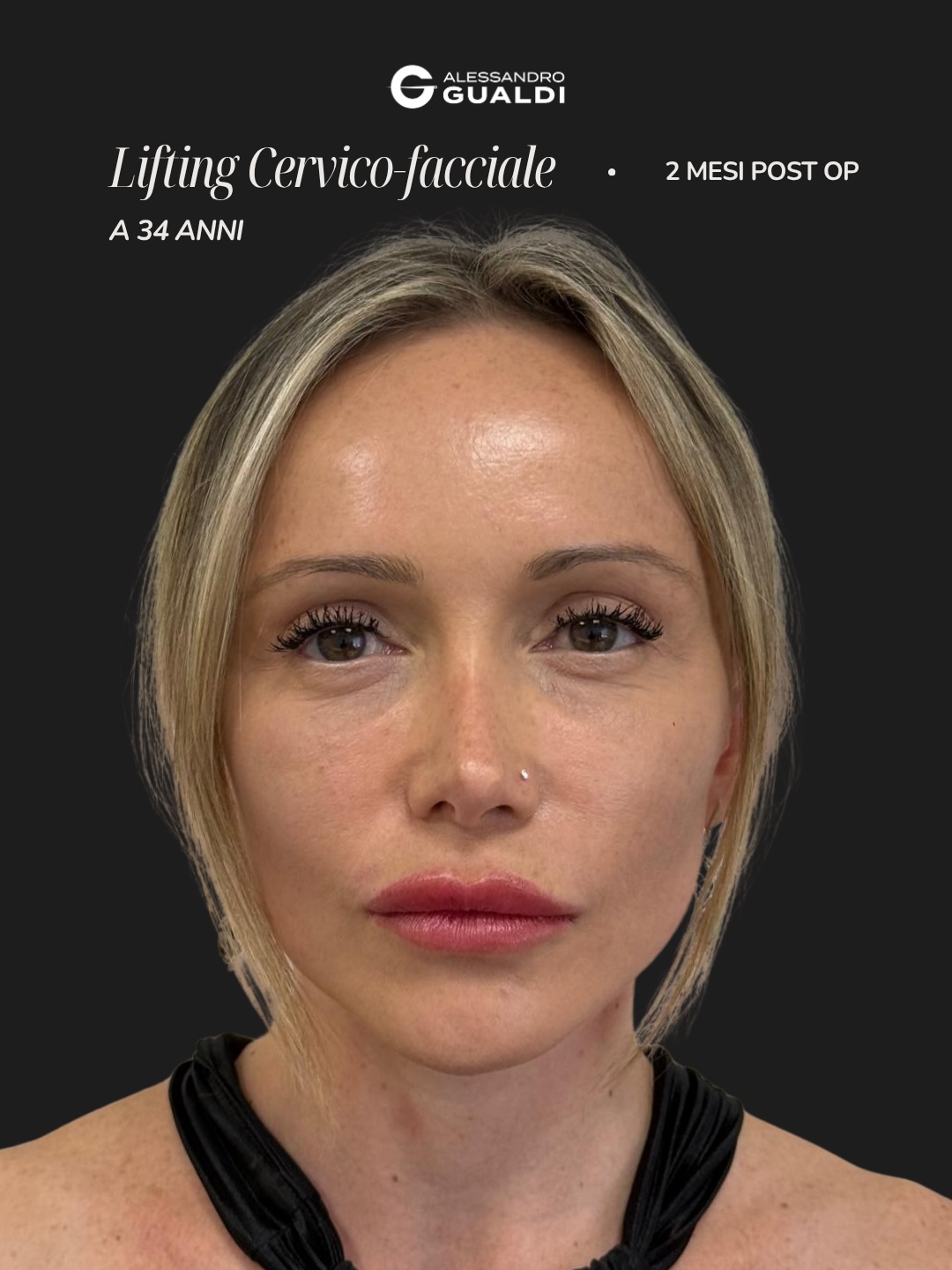 Lifting cervico-facciale di preservazione a 34 anni, prima e dopo a circa due mesi, immagine 1