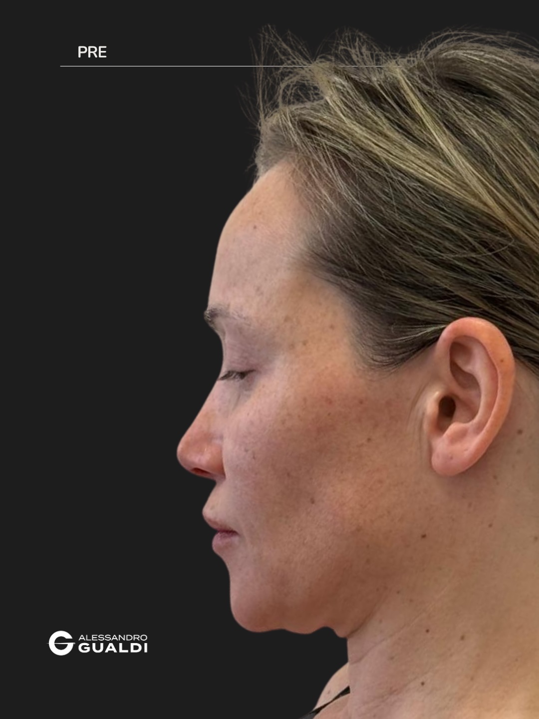 Lifting cervico-facciale di preservazione a 34 anni, prima e dopo a circa due mesi, immagine 2