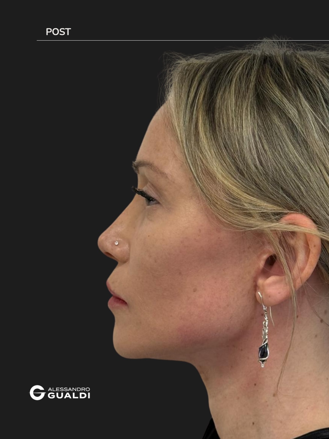 Lifting cervico-facciale di preservazione a 34 anni, prima e dopo a circa due mesi, immagine 3