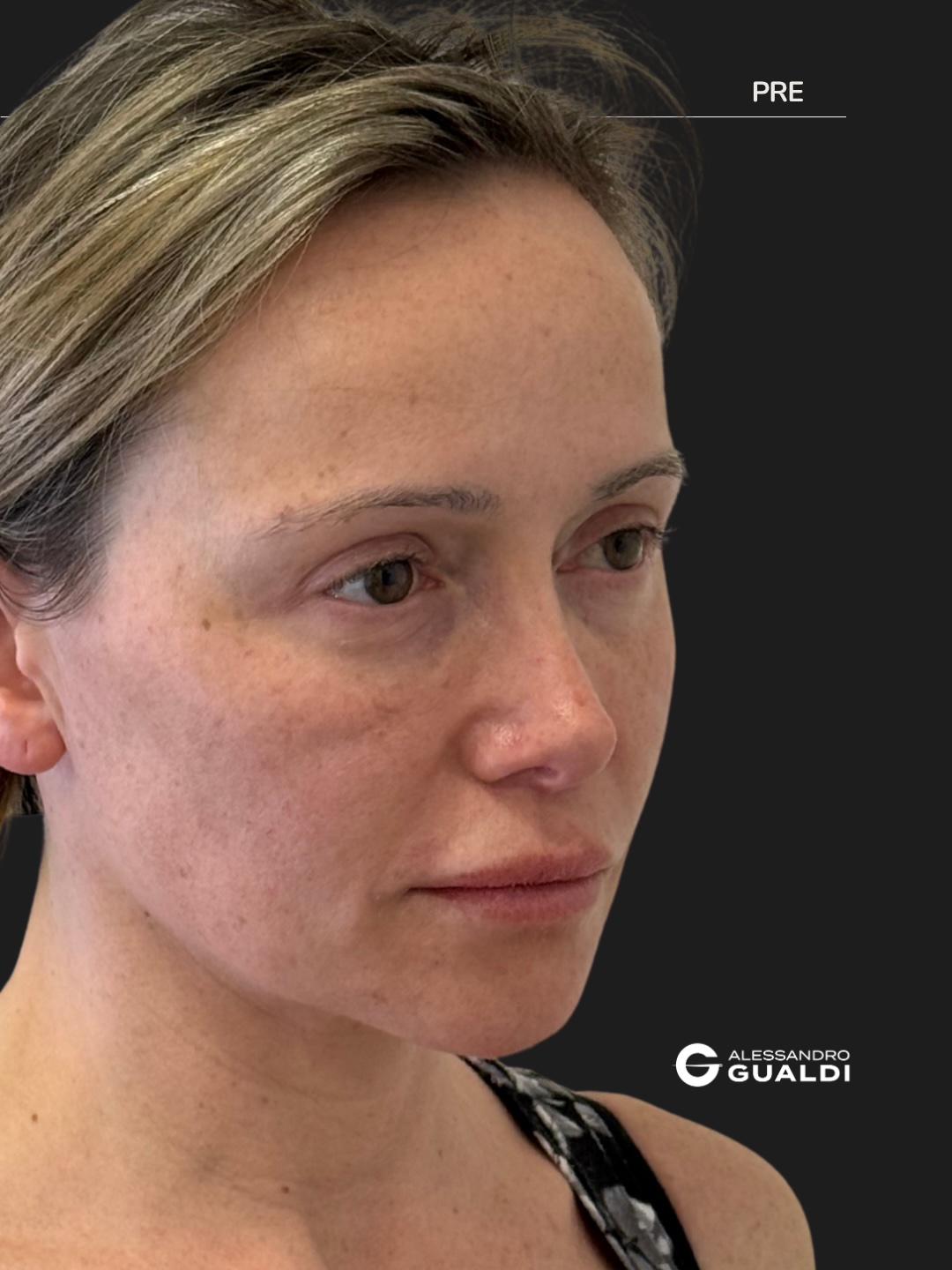 Lifting cervico-facciale di preservazione a 34 anni, prima e dopo a circa due mesi, immagine 4
