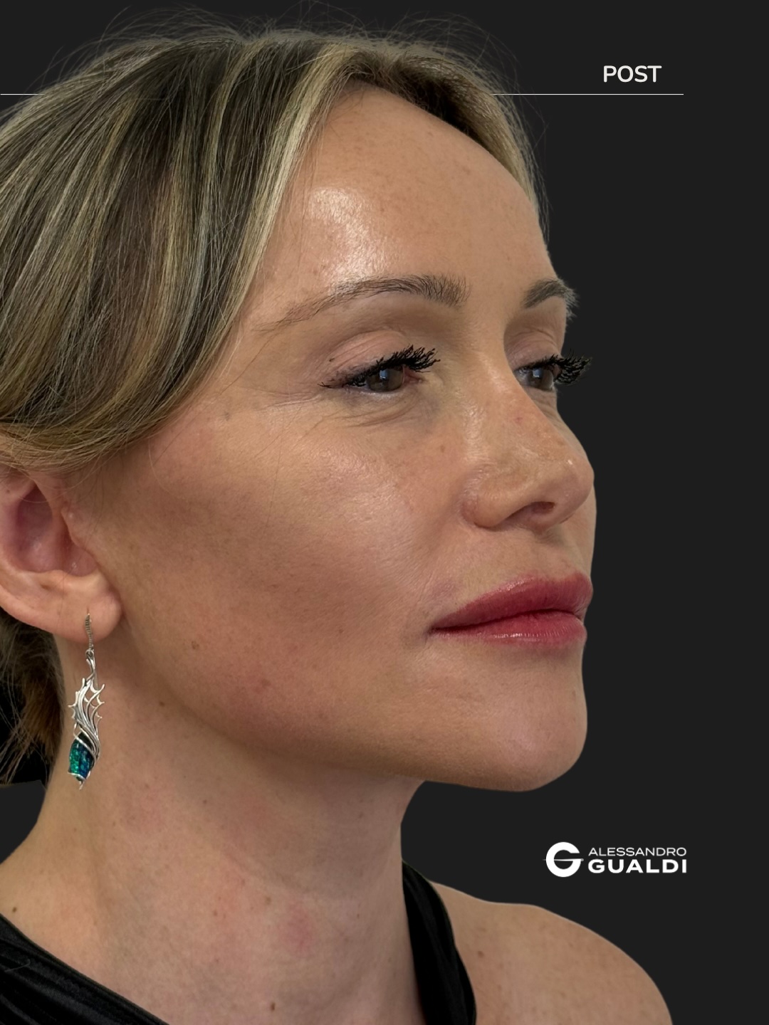 Lifting cervico-facciale di preservazione a 34 anni, prima e dopo a circa due mesi, immagine 5