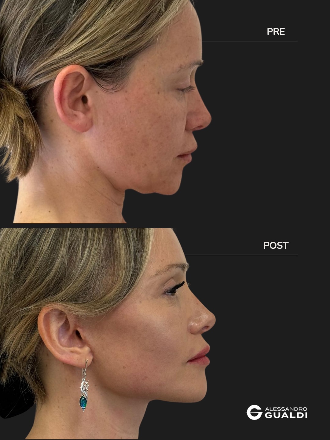 Lifting cervico-facciale di preservazione a 34 anni, prima e dopo a circa due mesi, immagine 6